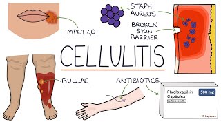 Understanding Cellulitis Skin and Soft Tissue Infections [upl. by Volin]