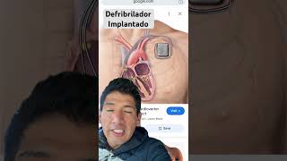 Defibrillator implantado [upl. by Niatsirt]