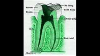 Periodontitis apical aguda [upl. by Bettye]