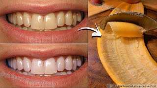 Secret that Dentists dont want you to know Remove Tartar and Teeth Whitening in just 2 minutes🪥🦷 [upl. by Enialed711]