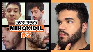 EVOLUÇÃO DE INSCRITOS  MINOXIDIL 2 [upl. by Ayiram]