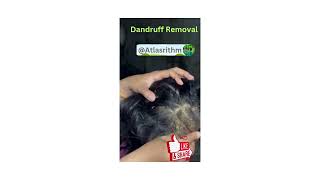 Dandruff Removal  Scratching a Patch of Dandruff Flaky Scalp  itchy scalp ASMAR Scalp care [upl. by Jeane]