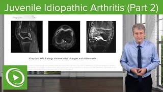 Juvenile Idiopathic Arthritis JIA Diagnosis amp Management – Pediatrics  Lecturio [upl. by Halliday]