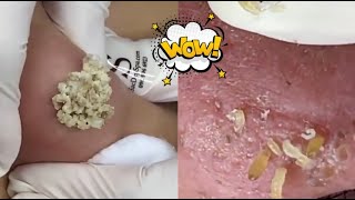 Ultimate Acne Treatment Compilation Top Tips amp Effective Solutions for Clear Skin [upl. by Neesay]