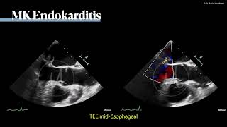 〖Echokardiografie〗 Mitralklappenendokarditis mit Ruptur der MK 🫀 [upl. by Debra]