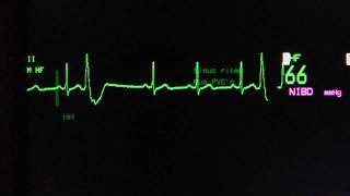 sinus rhythm with ventricular extrasystoles on an ECG heart monitor [upl. by Eelrebma]