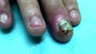 Finger infection Drainage Procedure [upl. by Normak725]