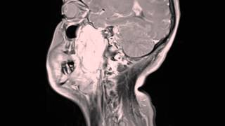 Rhabdomyosarcoma Maxllofacial Region [upl. by Pieter335]