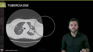 Padrões na tomografia de tórax  Aula de Radiologia SanarFlix [upl. by Arimay]