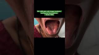 Bulbar Motor Neuron disease BL LMN palsy  tongue weakness wasting amp fasciculations neurology [upl. by Paddy186]