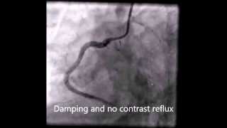 Bilateral coronary ostial stenosis secondary to syphilitic aortitis [upl. by Ely]