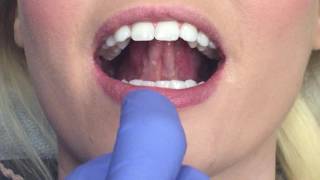 Oral Cancer Screening [upl. by Stein]