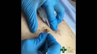 Removal of Seborrheic Keratosis [upl. by Nastassia574]