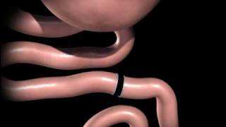 RouxenY Gastric Bypass [upl. by Quinta]