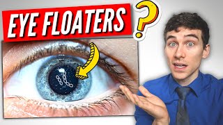 3 Must Know Facts About EYE Floaters [upl. by Sauls453]