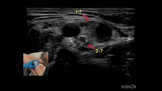 Axillary Brachial Plexus Sonoanatomical variation [upl. by Nalliuq]