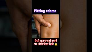 Pitting edema shorts short edema [upl. by Silverstein]