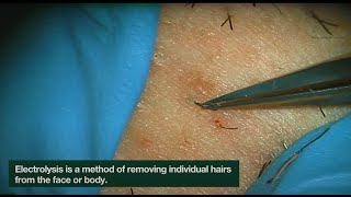 Electrolysis Ingrown Hair Removal  CLOSEUP  Here is how Electrolysis works  Jade Clinics [upl. by Renaud]