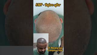 SMP Scalp micro pigmentation Before After pictures Video Result WhatsApp 919416500112 hair smp [upl. by Vevina]