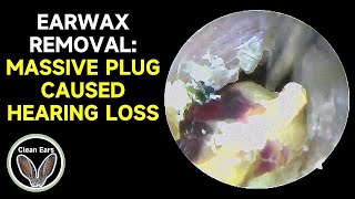 Cerumen Removal MASSIVE PLUG CAUSED HEARING LOSS [upl. by Annid]