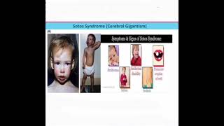 Sotos syndrome mrcpch Clinical [upl. by Eniluqcaj]