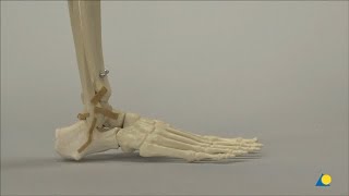 Ankle Arthrodesis Using an Anterior Approach [upl. by Nylaj]