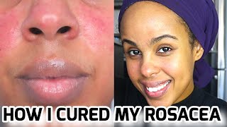 HOW TO GET RID OF ACNE  THE OIL CLEANSING METHOD  Natural skin care [upl. by Addam844]