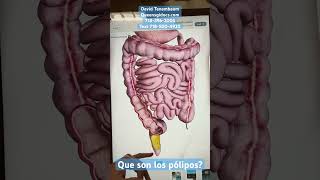 Que son pólipos en el intestino medico doctor polyps colonoscopy colonoscopia polipo gastro [upl. by Nosro]