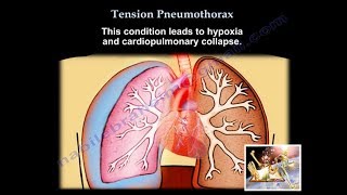 Tension Pneumothorax  Everything You Need To Know  Dr Nabil Ebraheim [upl. by Oretna712]