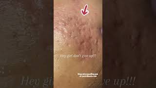 Effective method for removing deep acne scars [upl. by Meenen]