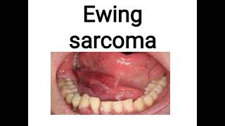 Ewing sarcoma [upl. by Atsira199]