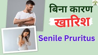 खारिश से परेशान Homeopathic approach to itching Senile pruritus treatment Itch without eruptions [upl. by Ordnajela]