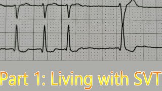 HEARTRATE of 250 Living with AVNRTSupraventricular Tachycardia SVT Part 1 [upl. by Eenad]