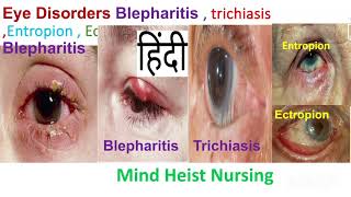 Eye DisordersBlepharitis  trichiasis Entropion  Ectropion Medical Surgical II 3rd Bsc Nursing [upl. by Aizatsana]