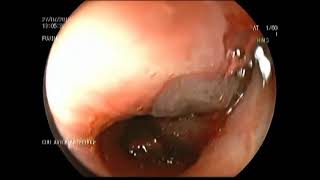 Managing Live Leech and Roundworm Endobronchial Infestation [upl. by Frasch]