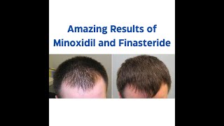 Minoxidil and Finasteride 5 Topical Solution  Before and After Result  One Month Journey [upl. by Treat149]