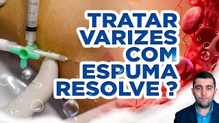 Como resolver varizes espuma densa laser cirurgia qual o método definitivo para a circulação [upl. by Ambrosius495]