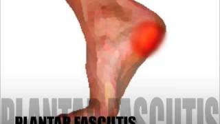 Plantar Fasciitis Diagnosis amp Treatment [upl. by Paxon]