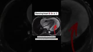 Heart Dancing Around in HUGE Pericardial Effusion [upl. by Nohpets838]