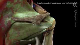 Necrotizing Fasciitis from Infected Needle [upl. by Southard]