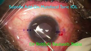 Sulcofix Addon Toric Multifocal IOL Implantation [upl. by Enilec484]