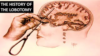 The Rise and Fall of The Lobotomy [upl. by Anwahsat905]