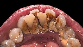 Crowding Teeth Will Increase Tartar Buildup  Scaling [upl. by Ardnayek]