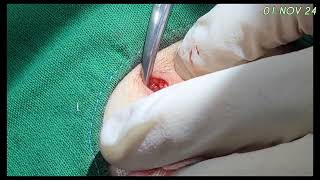 멍울 Neurofibroma on the knee [upl. by Shornick]