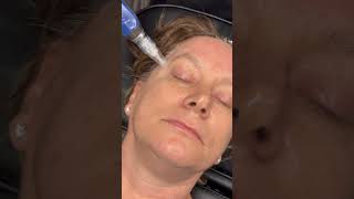 Microneedling [upl. by Vanden]