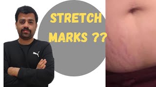 Stretch marks homeopathic treatment pregnancy marks  striae gravidarum [upl. by Elfrida568]