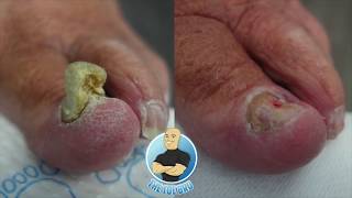 TRIMMING A quotTHICCquot TOENAIL  AMAZING BEFORE AND AFTER [upl. by Ponce]