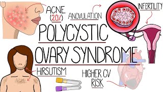 Polycystic Ovary Syndrome Made Easy PCOS Explained [upl. by Staford]