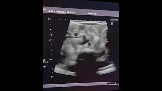 Sonographic quotWhirlpoolquot sign in neonate with Intestinal Malrotation [upl. by Nirag274]