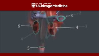 Animation of a Total Heart Transplant [upl. by Ardnahsal]